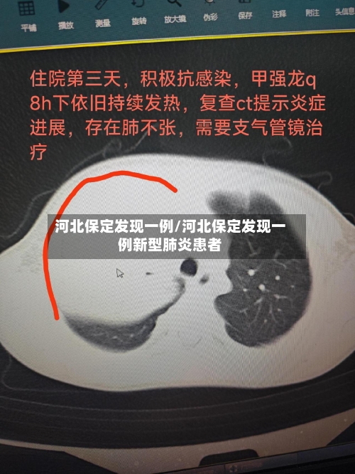 河北保定发现一例/河北保定发现一例新型肺炎患者